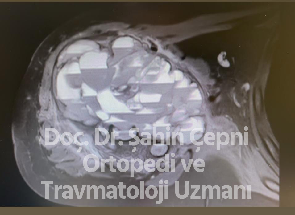 Anevrizmal Kemik Kisti