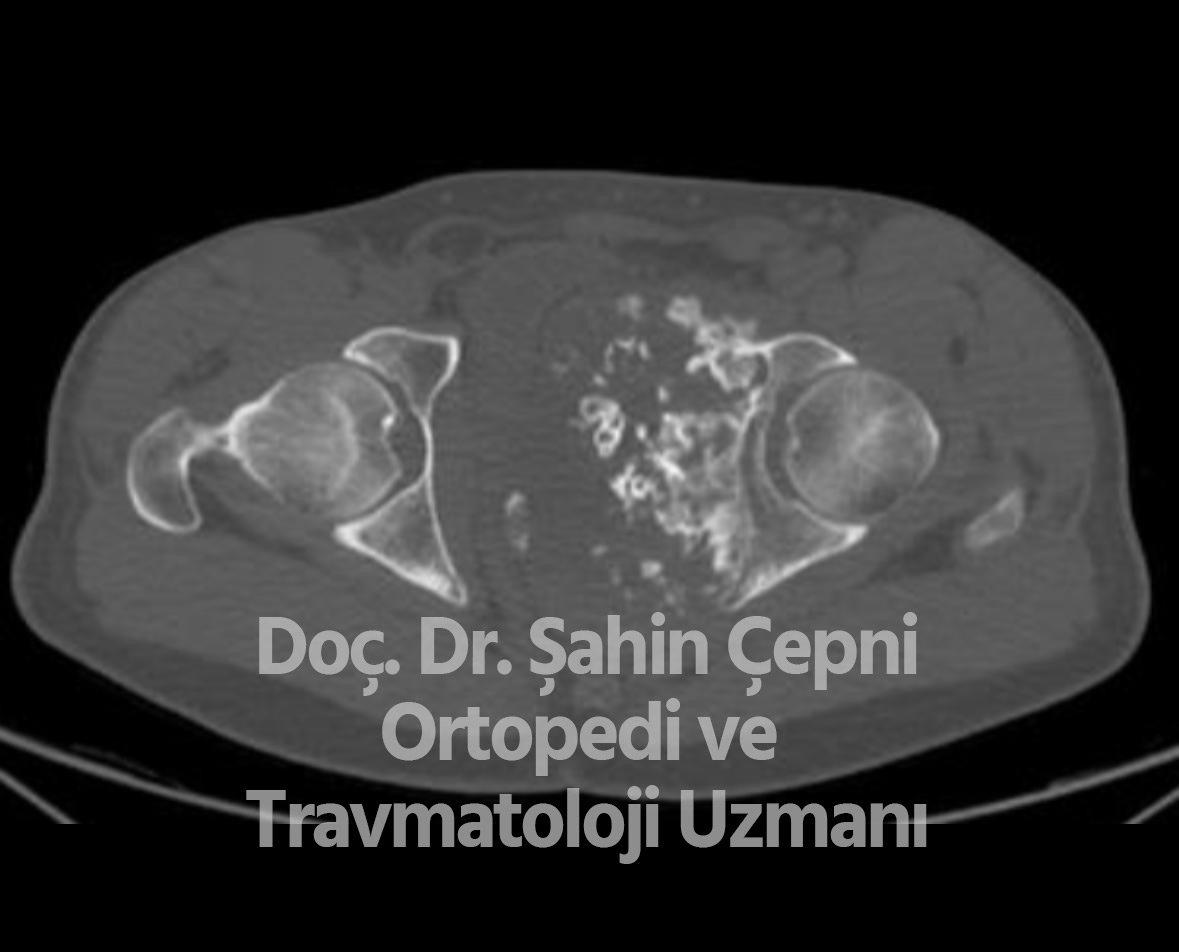 Kondrosarkom Kemik Tümörü