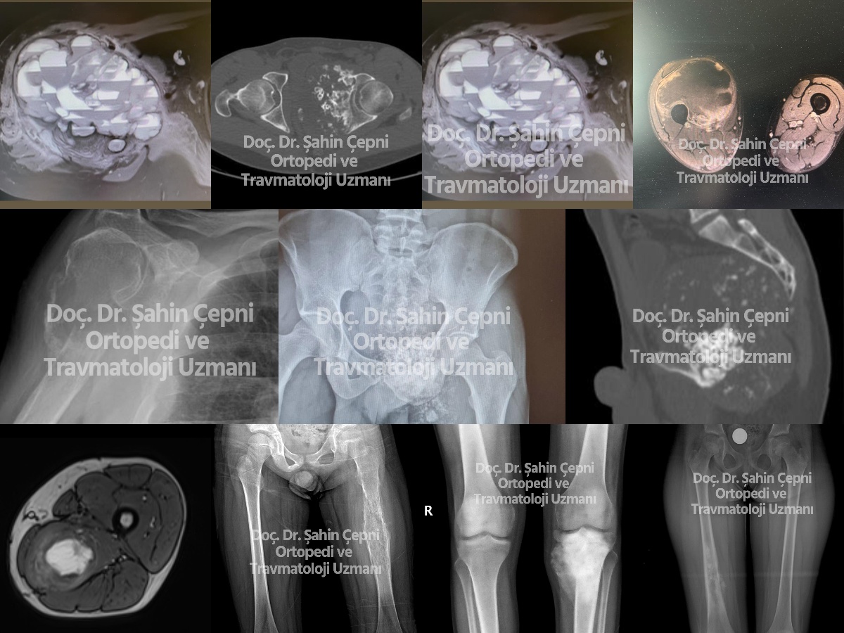 Kemik Tümörü Ameliyatı Olanlar Yorumları